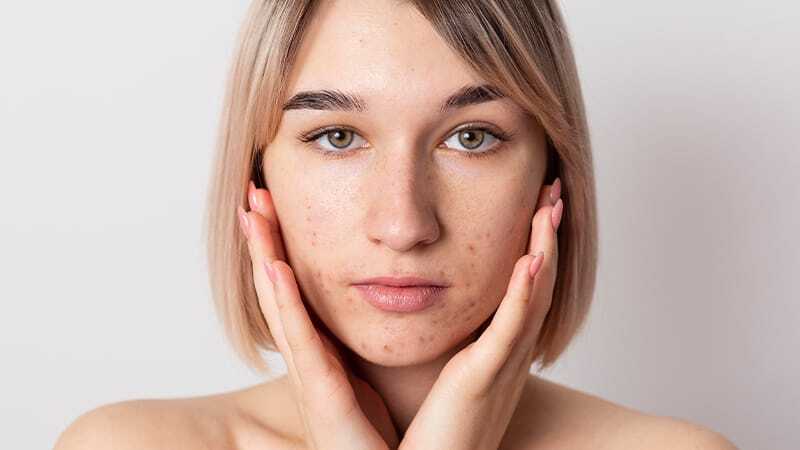 CBD gegen Akne und Pickel - hilft Cannabidiol bei unreiner Haut? | CBD bei Akne CBD bei Akne | Edelhanf - Ihr Premium CBD Shop